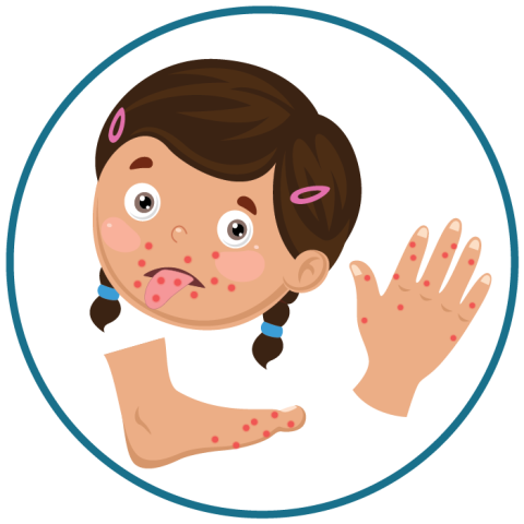 Illustration showing rash on face, feet, and hands